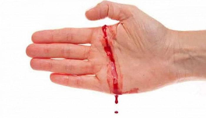Nằm mơ người khác vô tình bị đứt tay chảy máu Nằm mơ người khác vô tình bị đứt tay chảy máu